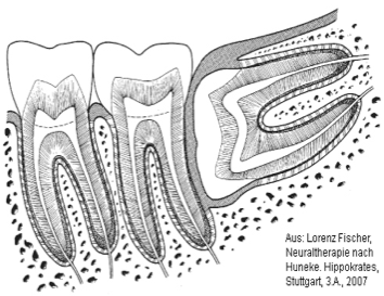 NEURAL_THERAPY_-_WISDOM_TOOTH